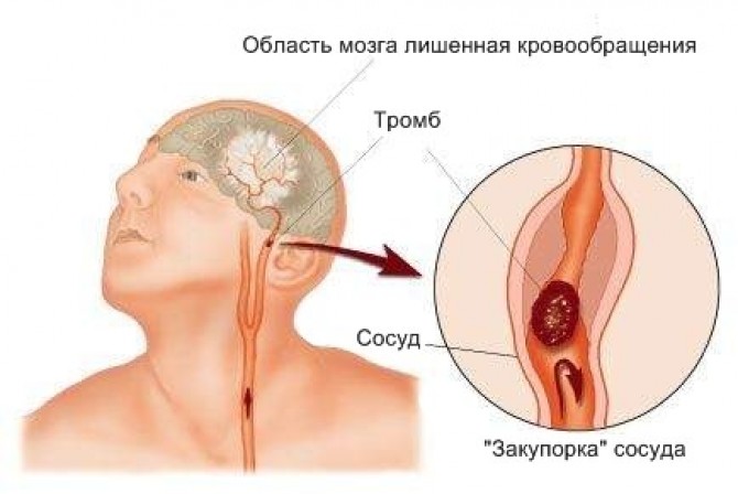 Острый ишемический инсульт: диагностика и лечение