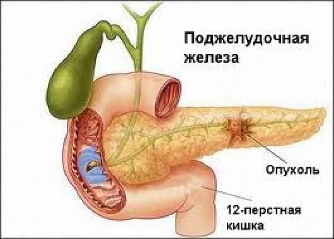 Рак поджелудочной железы – постановка диагноза
