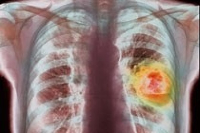 Постановка точного диагноза: определение стадии немелкоклеточного рака легкого(НМРЛ)(стадирование)