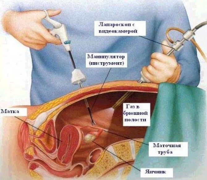 Что такое лапароскопия яичников и кому она показана