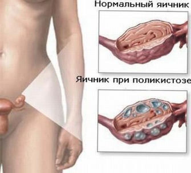 Лечение поликистоза без гормонов – возможно ли это?