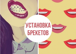 Все о брекетах и выравнивании зубов