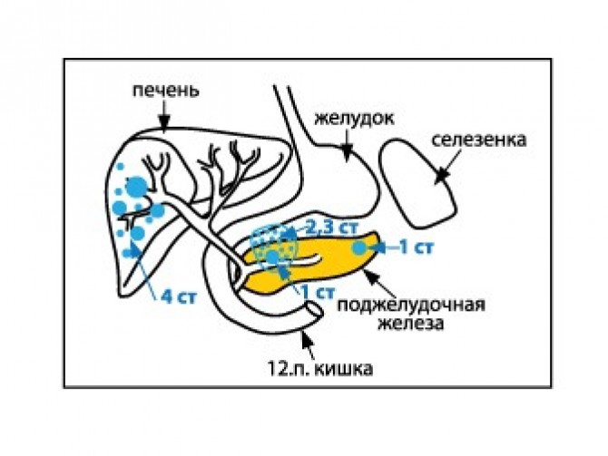 Комбинация химиотерапии и лучевой терапии (ХЛТ) с курсом индукционной химиотерапии при раке поджелудочной железы на поздних стадиях: британский межуниверситетский опыт